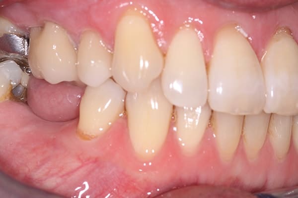 cerec-restorations-case-1-ba