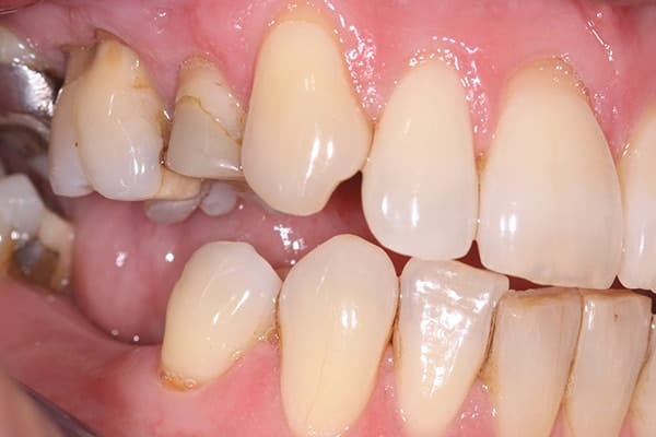 cerec-restorations-case-1-bb