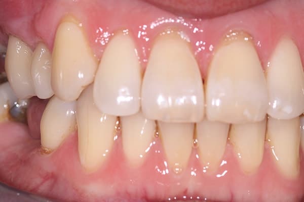 cerec-restorations-case-1-fa