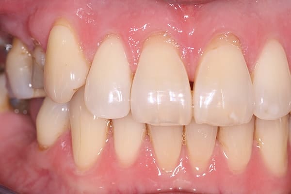 cerec-restorations-case-1-fb