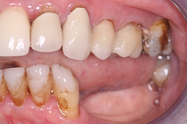 cerec-restorations-case-2-ba