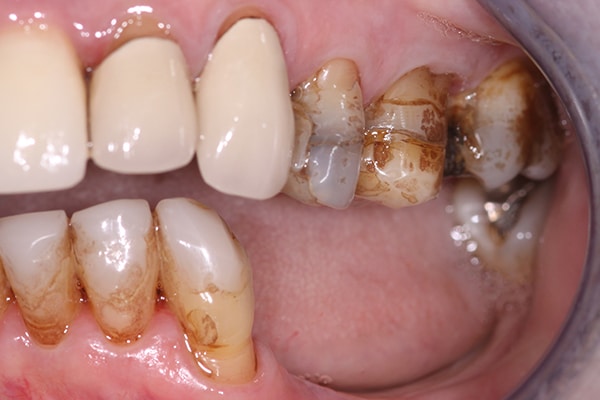 cerec-restorations-case-2-bb