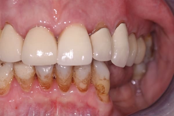 cerec-restorations-case-2-fa