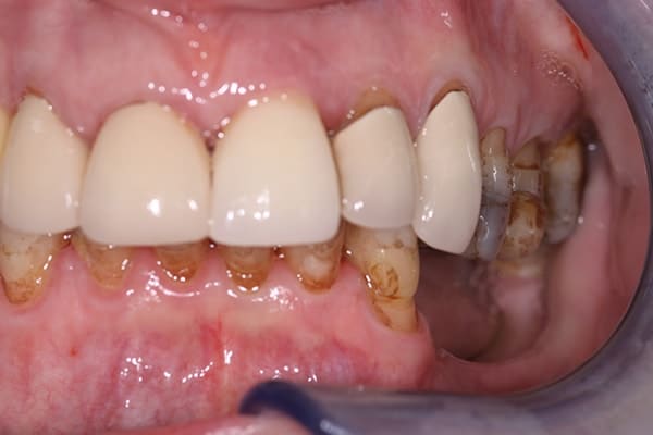 cerec-restorations-case-2-fb