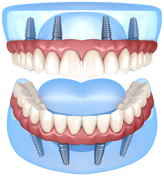 dental-implants-01 $variable({"type":"content","value":{"name":"post_title","settings":{"before":"","after":""}}})$