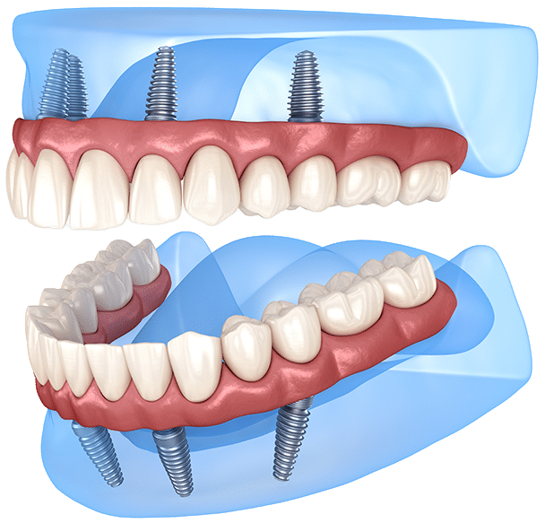 dental-implants-02 $variable({"type":"content","value":{"name":"post_title","settings":{"before":"","after":""}}})$