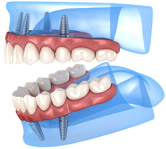 dental-implants-03 $variable({"type":"content","value":{"name":"post_title","settings":{"before":"","after":""}}})$