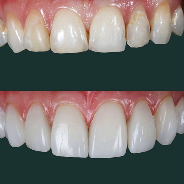 composite-bonding-leicester-1-1