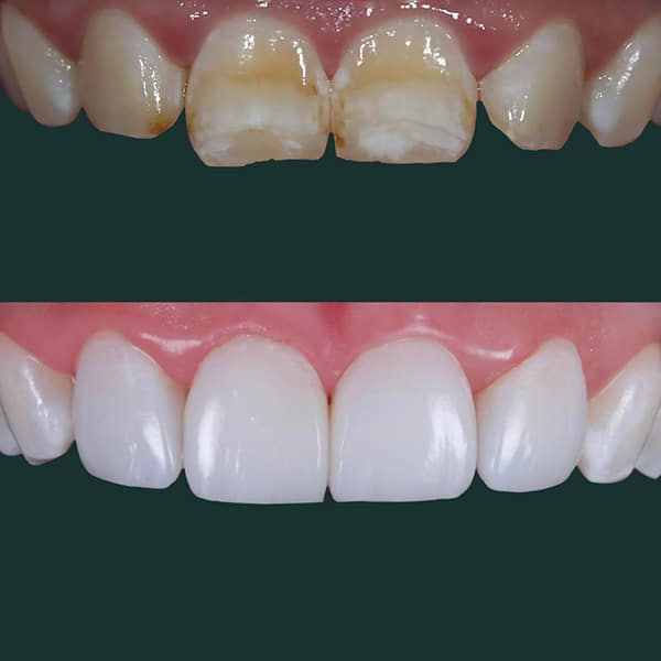 composite-bonding-leicester2-2