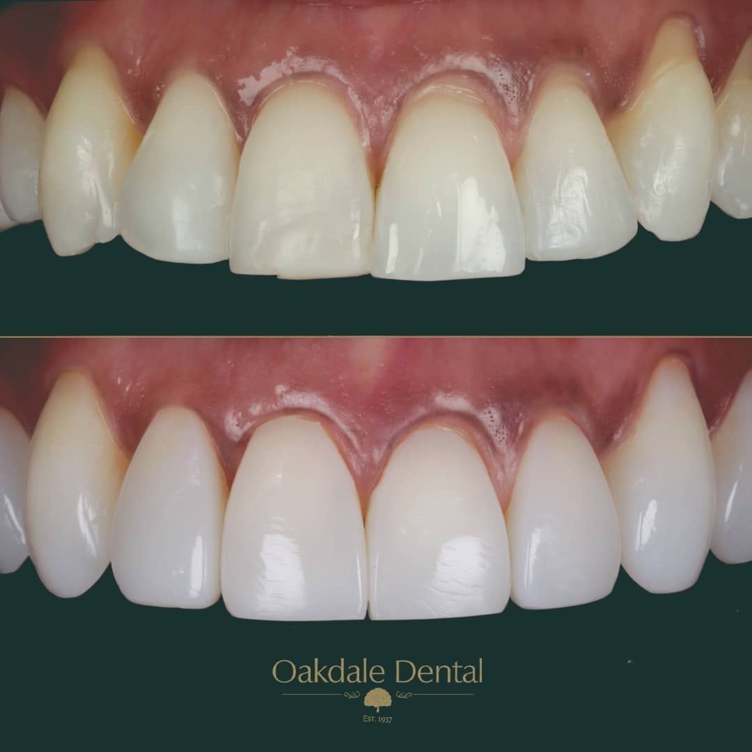 composite bonding leicester