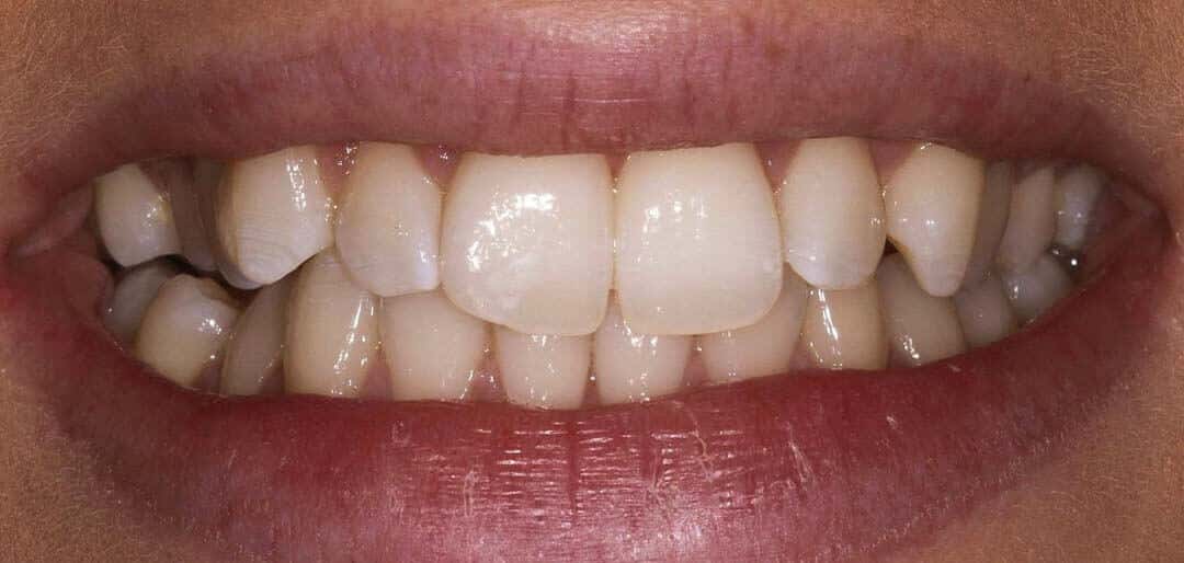 Whitening 6