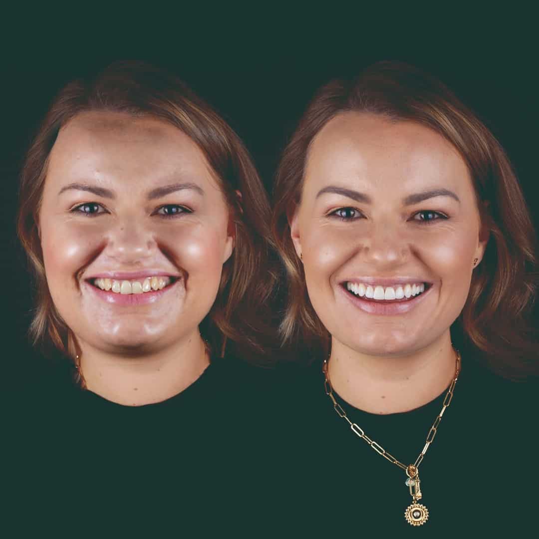 before-after-brace-oakldale-1