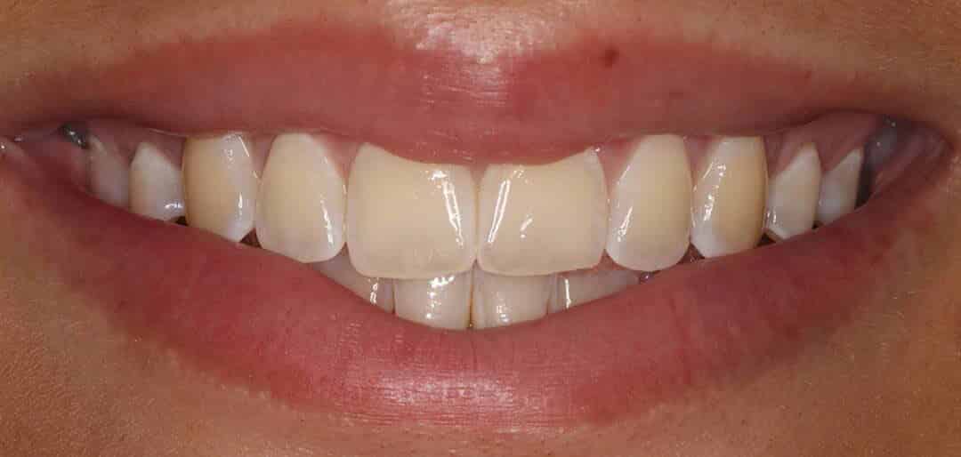 whitening 1