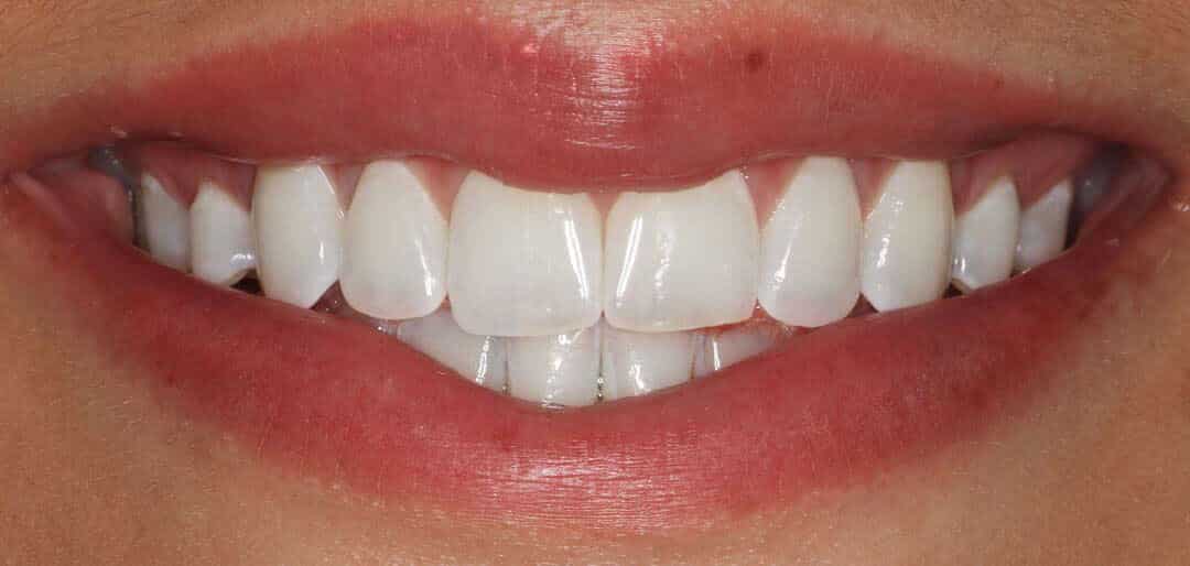 whitening 1a