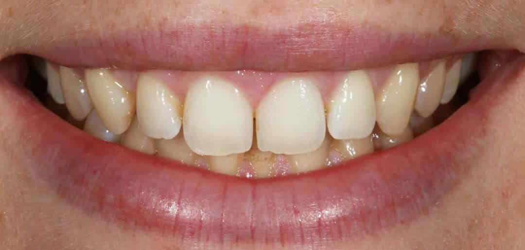 whitening 3