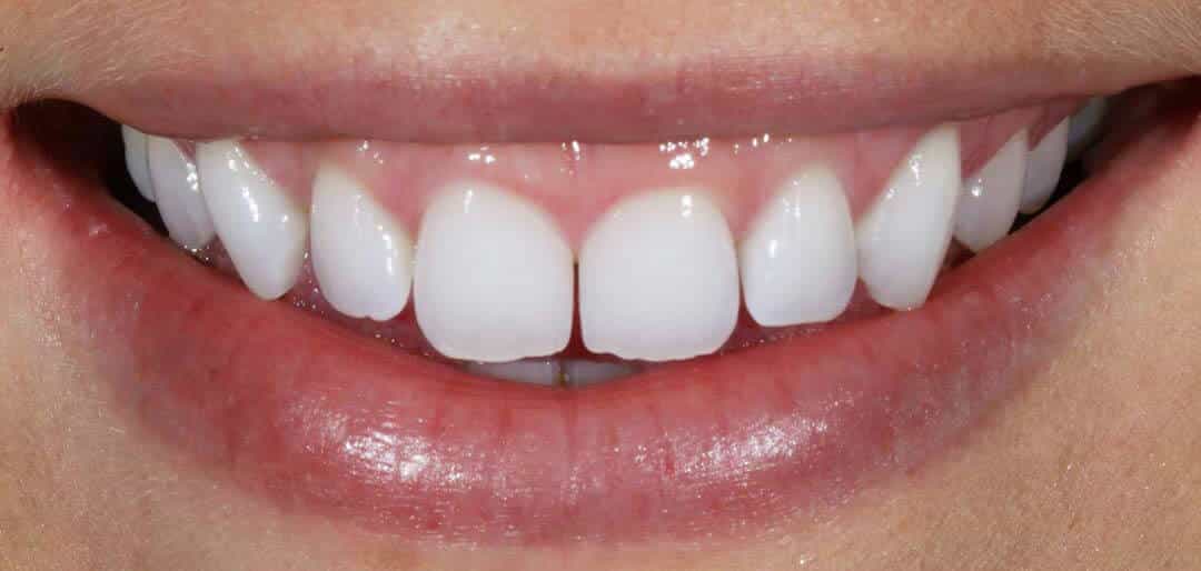 whitening 3a