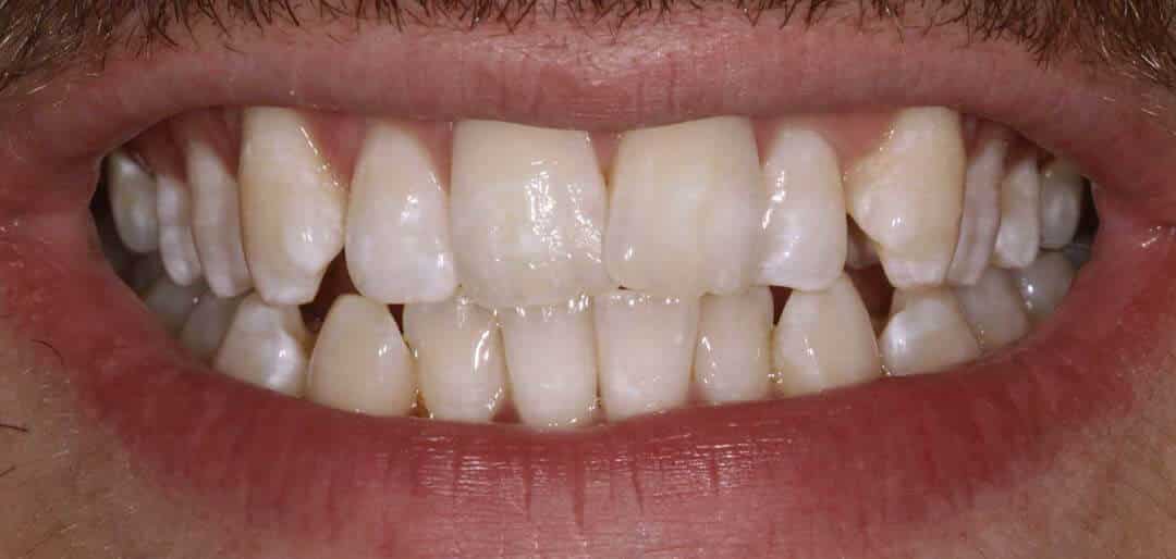 whitening 4