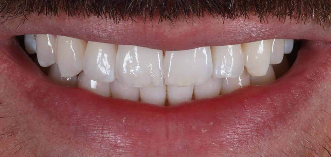 whitening 4a