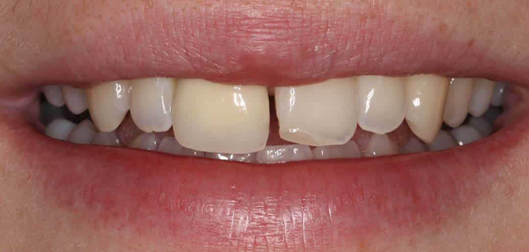 whitening 5