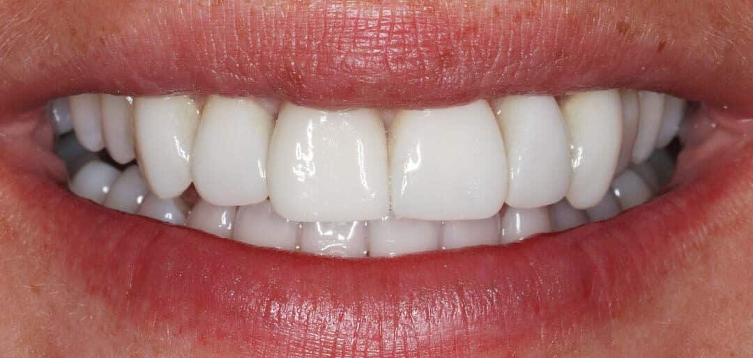 whitening 5a