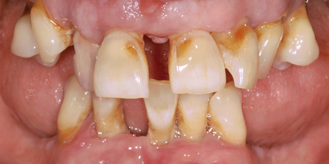 dental-implants-2a