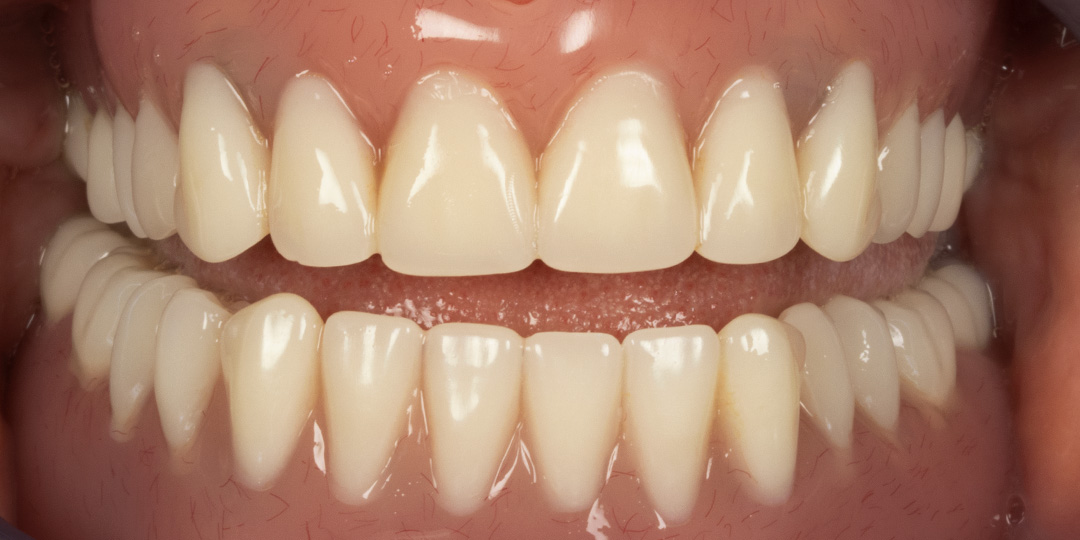 dental-implants-2b