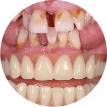 Total Replacement Multiple Tooth Replacement, Leicester