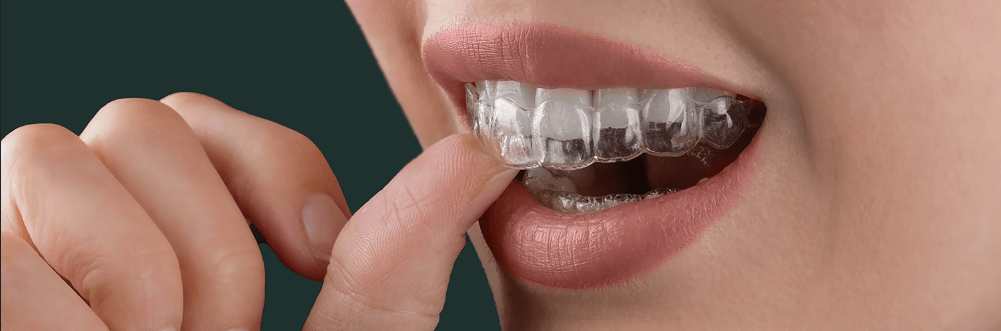 Invisalign Braces Leicester