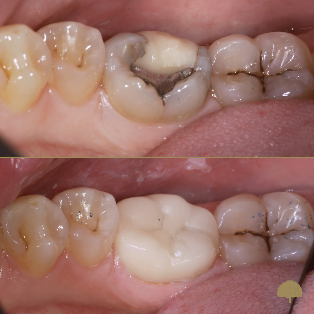 cerec exapmple $variable({"type":"content","value":{"name":"post_title","settings":{"before":"","after":""}}})$