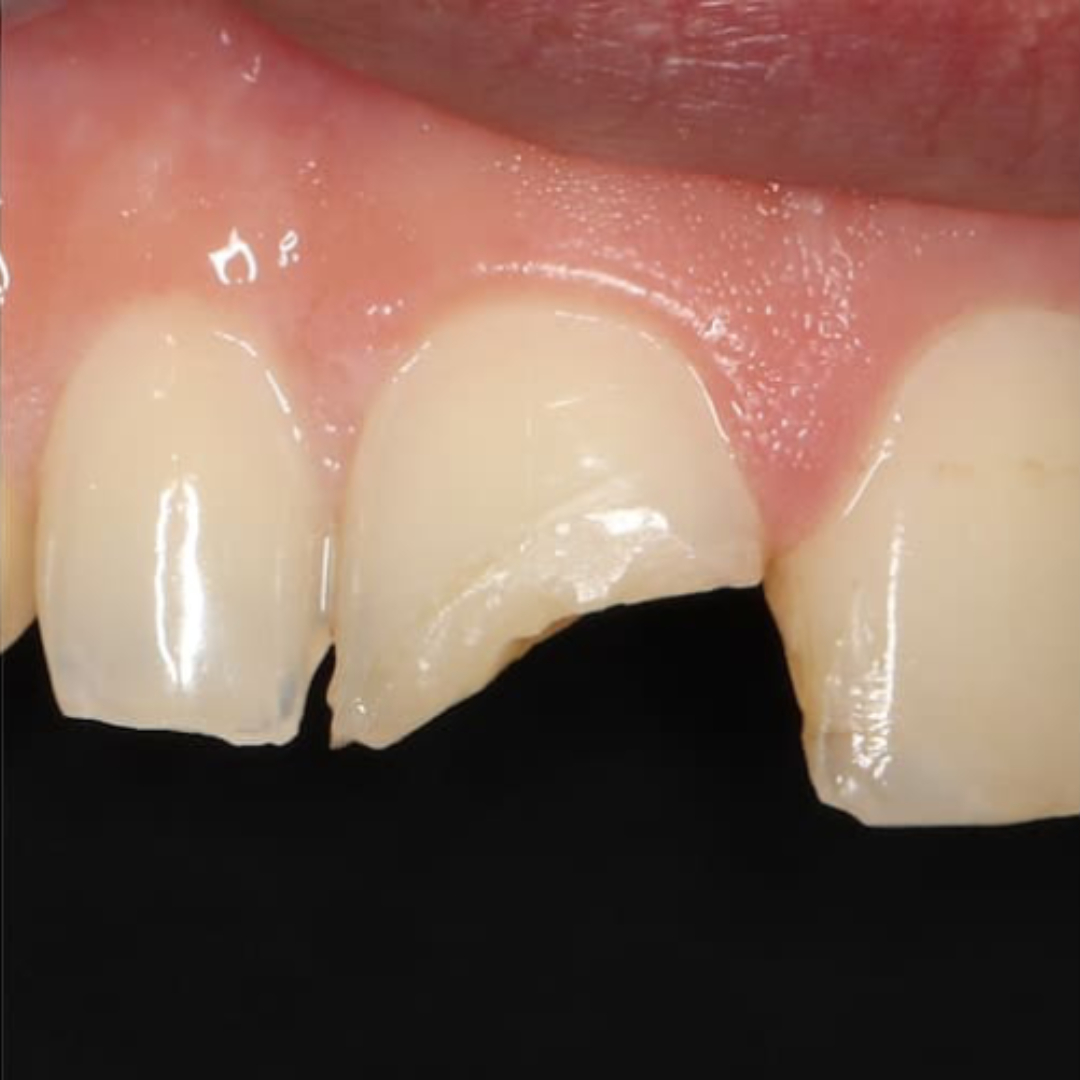 Broken teeth $variable({"type":"content","value":{"name":"post_title","settings":{"before":"","after":""}}})$