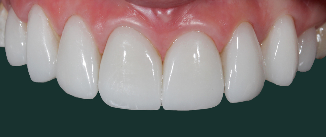 Veneers 1a