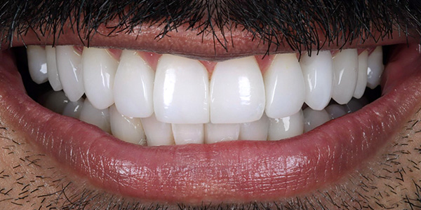 Implant 1