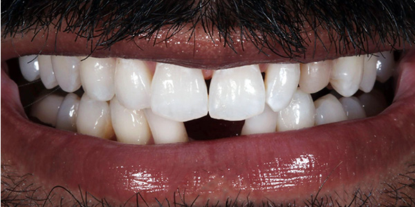 Implant 1a