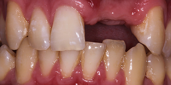 Implant 2