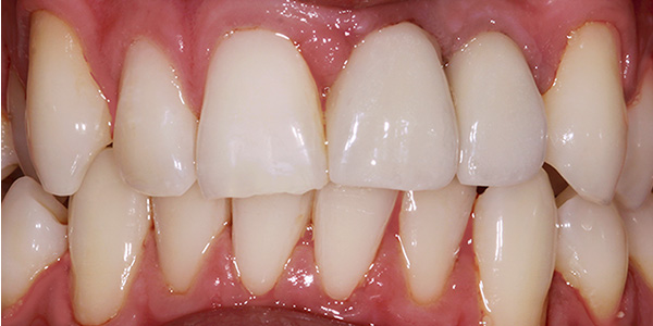 Implant 2a