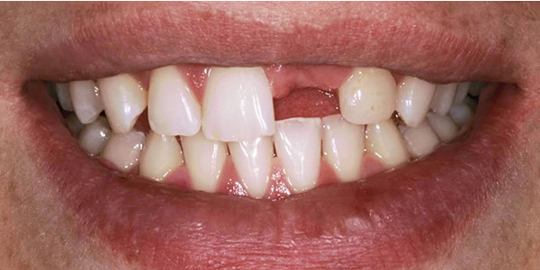 Implant 3