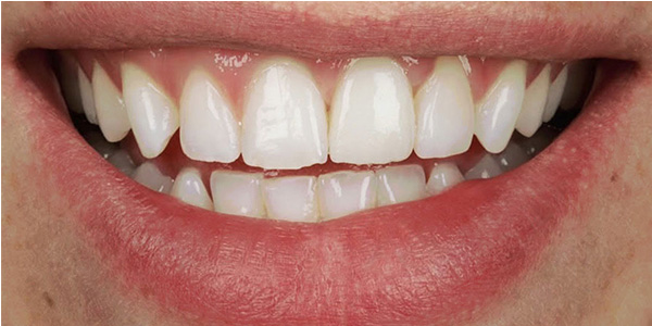 Implant 3a