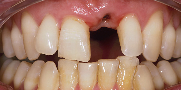 Implant 4