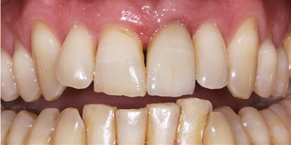 Implant 4a