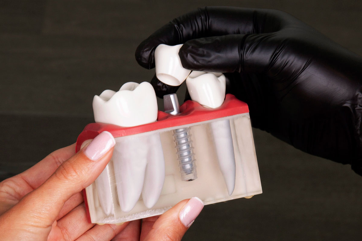 Dental Implant