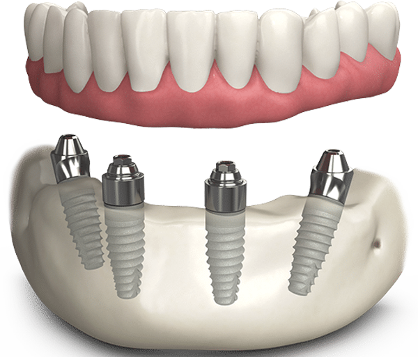 all-on-4 all-on-4-dental-implants-leicester-oakdale-dental
